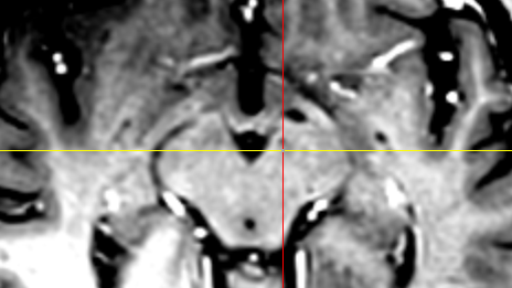 Impedance-based navigation in the brain